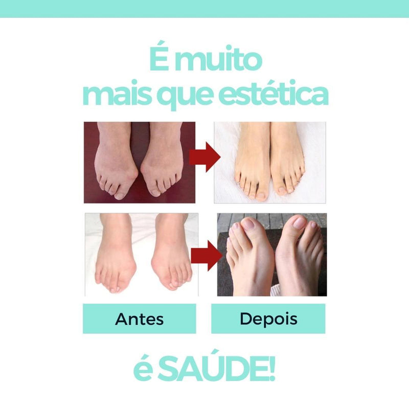 CORRETOR ORTOPÉDICO PARA JOANETE